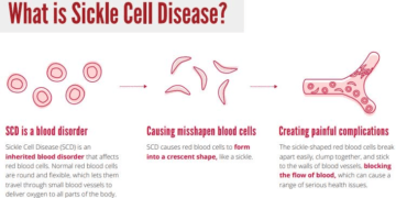 Know The Sickle Cell Disease
